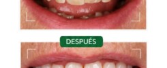 Centro Dental Orotava - Carillas dentales