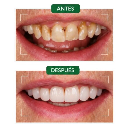 Centro Dental Orotava - Carillas dentales
